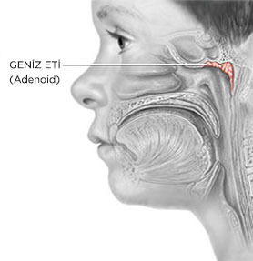 Geniz Eti Ameliyatı (Adenoidektomi )