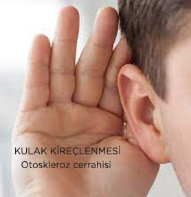 Kulak  Kireçlenmesi  İşitme Kaybı Otoskleroz